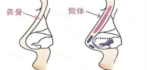 福州做鼻子整形需要多少钱？自体软骨隆鼻1.2w+/假体隆鼻1.6w+/鼻综合2.8w+/鼻修复1.7w+