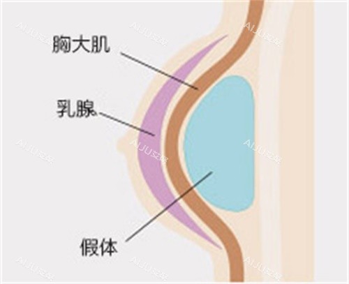 棒棒糖隆胸示意图