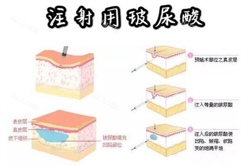 长沙艺星整形玻尿酸注射示意动画图