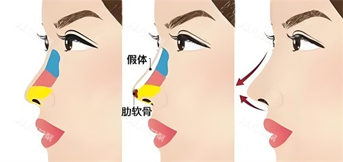 半肋骨隆鼻手术展示动画图