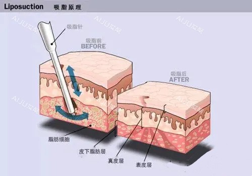 长沙艺脂水动力吸脂手术原理动画图