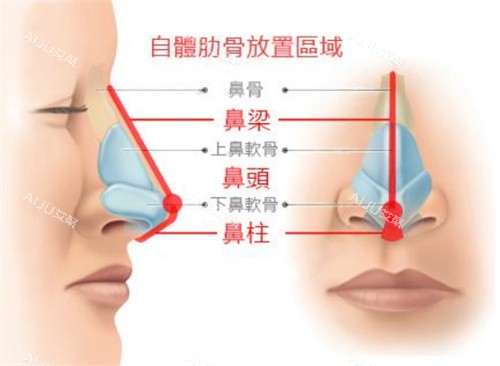 鼻部整形示意图