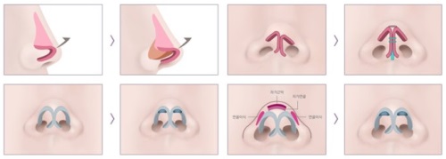 鼻修复示意图