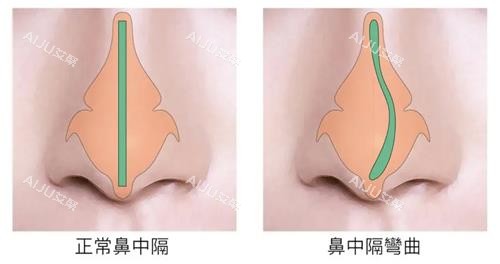 鼻中隔偏曲和正常鼻子的对比