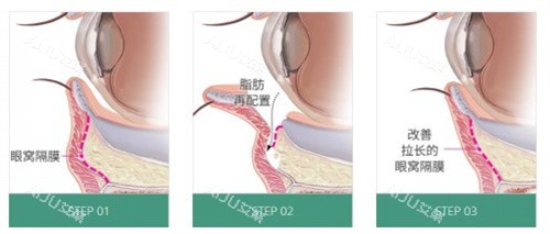 眼底脂肪重排术