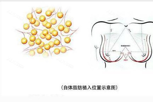 脂肪隆胸示意图4