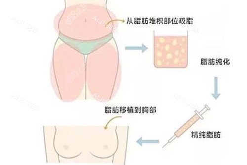 脂肪隆胸示意图