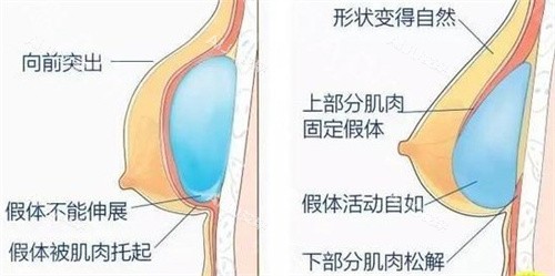 内窥镜隆胸