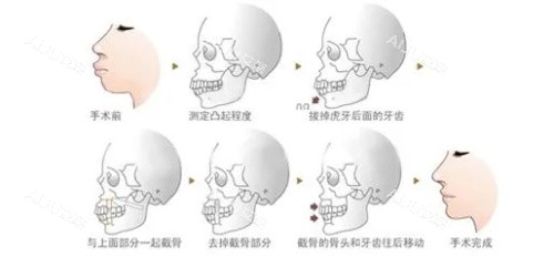 正颌手术步骤图示