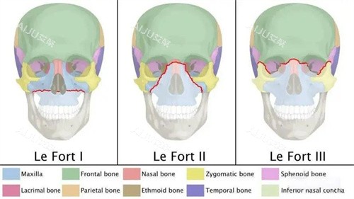 Le Fort三种手术方式演示图