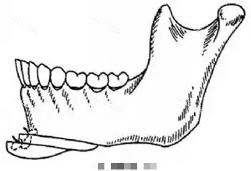 下颏截骨成型卡通示意图
