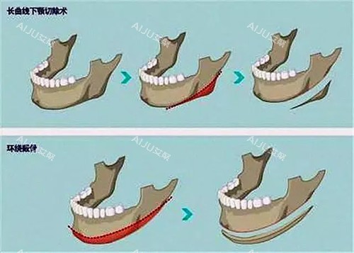 不同下颌骨结构方式对比图