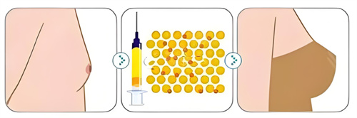 自体脂肪隆胸对比