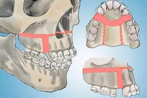 正颌手术示意图