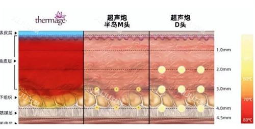 超声炮治疗深度对比