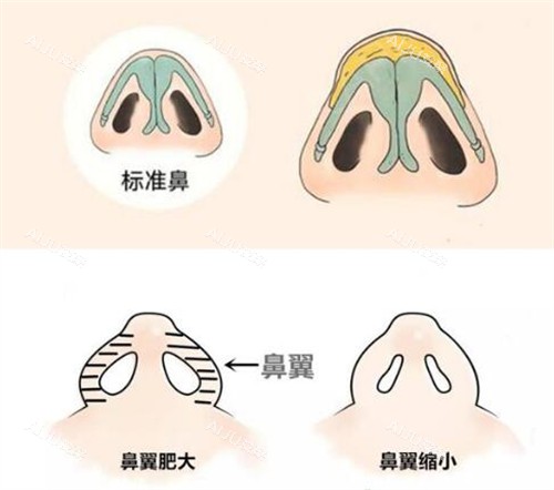 手术缩鼻翼多少钱？价格在5k+，受地区经济/医院级别/手术难度/个人需求等因素影响