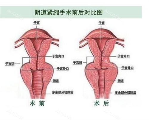 阴道紧缩手术前后对比图