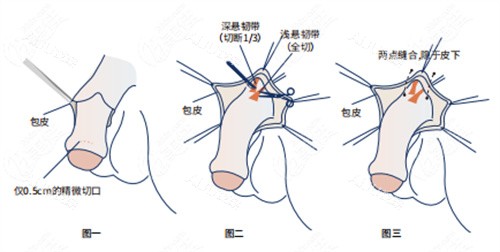 阴茎增长手术详细步骤演示动画图