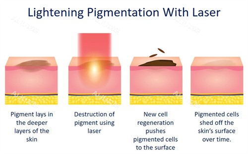 激光祛斑如何改善皮肤斑点