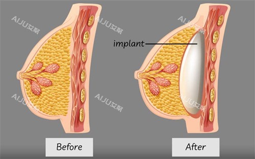 假体隆胸植入的层次