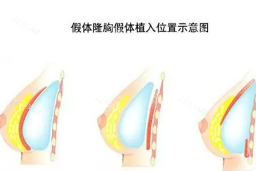 西宁做隆胸手术一般多少钱？自体脂肪隆胸1.4w+|假体隆胸2.5w+|注射隆胸8k+价格都不同