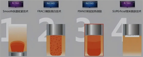 fotona4d欧洲之星四种模式