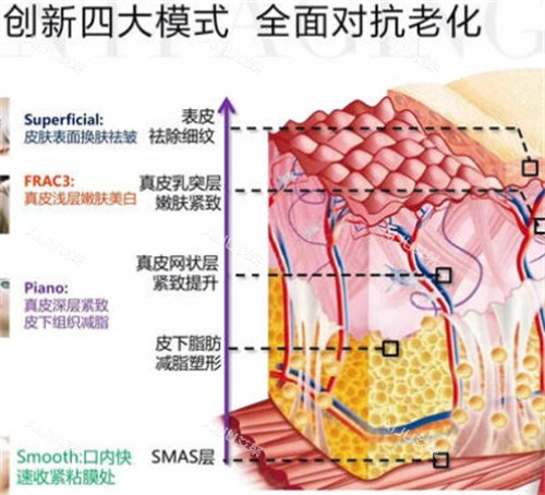 fotona4d欧洲之星不同模式对应层次