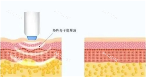 铁铁收藏啦!2024做热玛吉全脸部价格表：眼部450发4k+/颈部900发9k+/面部300发8k+