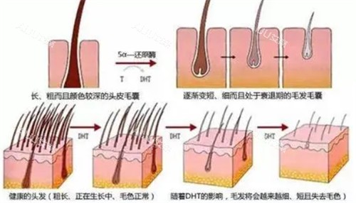 公布昆山地区植发手术价格表清单：FUT技术/FUE技术/微针技术/不剃发植发价格全都有