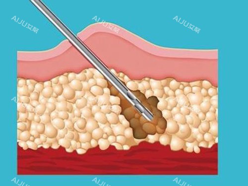 吸脂针图片