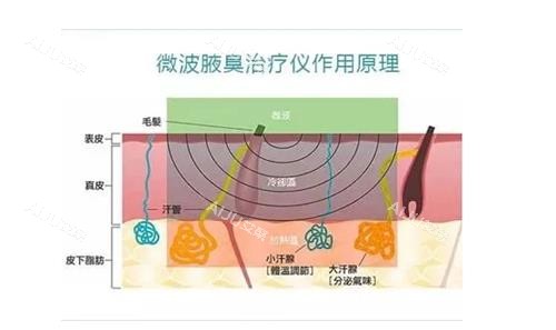 miradry微波治疗原理