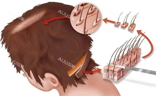 毛囊移植部位演示图