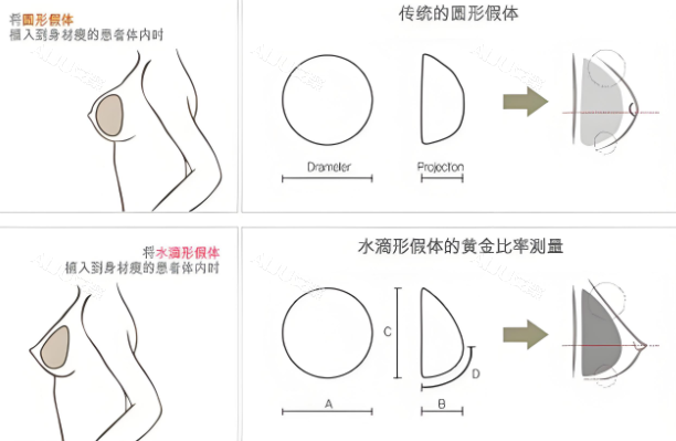 深圳正规医院隆胸需要多少钱？自体脂肪隆胸1.5w+/国产假体隆胸1w+