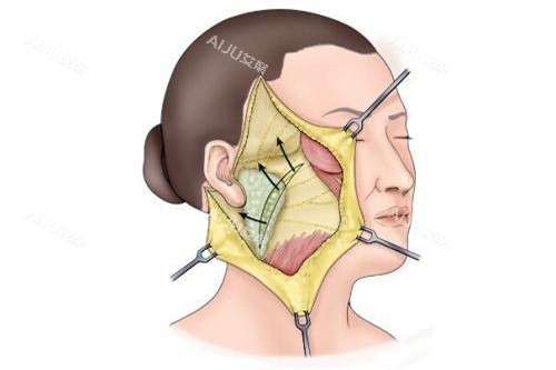 发际耳后切口拉皮手术示意图