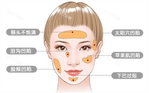 今年做面部脂肪填充大概多少钱？在线公布北京/上海/深圳/广州面部脂肪填充价格表