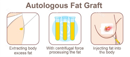 自体脂肪隆胸手术过程