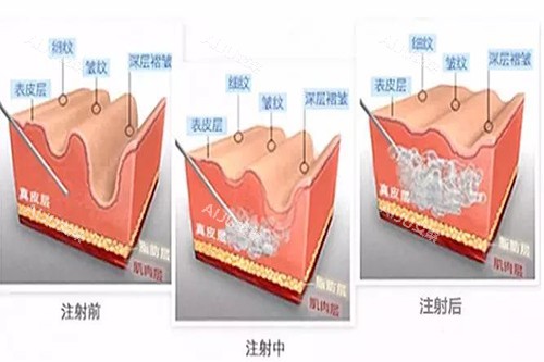 玻尿酸注射皮肤内在过程示意图