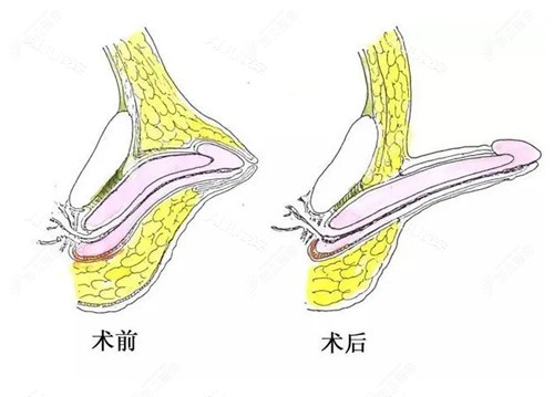 玻尿酸男性阴茎增长手术示意图