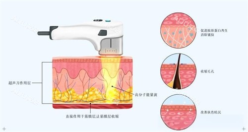 热玛吉有溶脂成效吗?有一定溶脂功效,但主要针对浅层脂肪!盘点常见的面部溶脂项目~