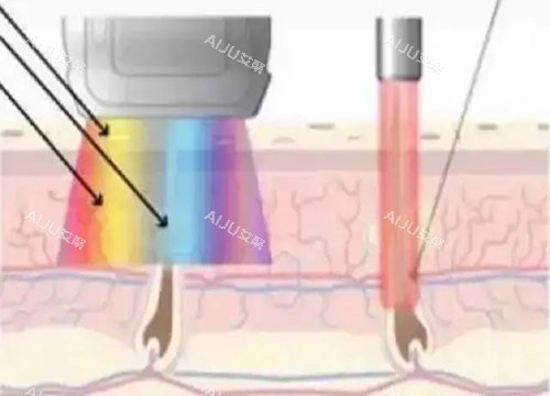 激光祛疤作用光波示意图