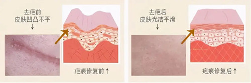 激光祛疤卡通示意图