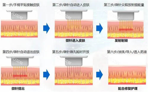 微针操作流程图解