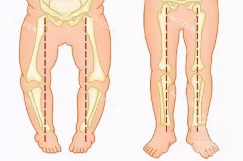 O型腿与正常腿型对比图