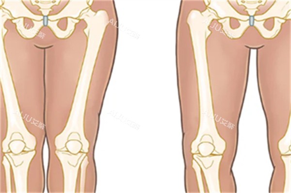 O型腿和直腿的区别图解