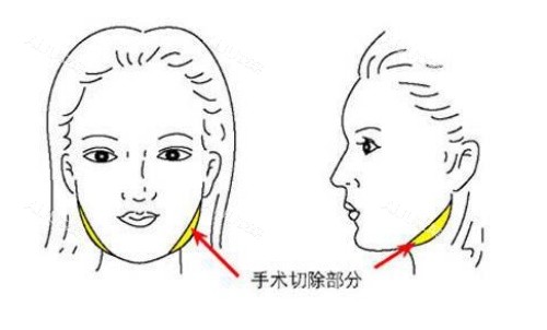 磨骨会比一般人老得快吗？从磨骨原理等多方面分析来看磨骨后并不会导致衰老加速