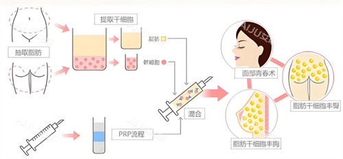 自体脂肪隆胸过程