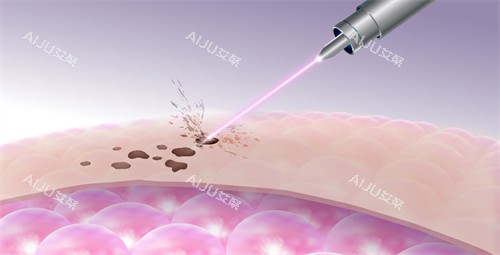 激光改善皮肤斑点