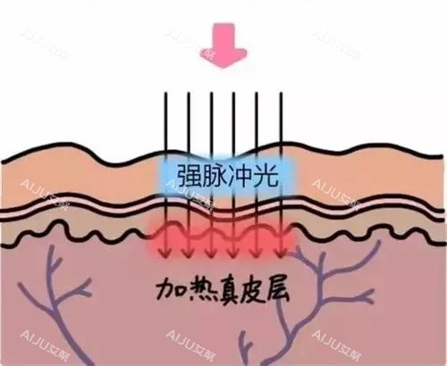 光子嫩肤针对的皮肤层