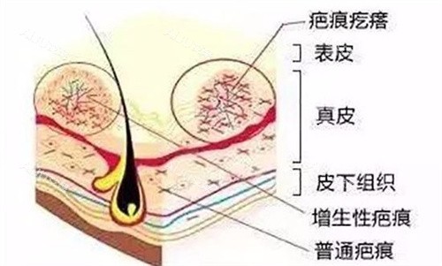 疤痕疙瘩皮肤解析图