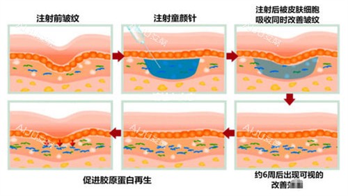 注射童颜针皮肤前后对比图